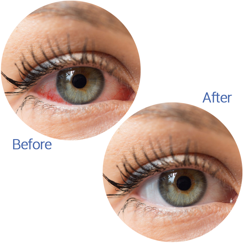 before after