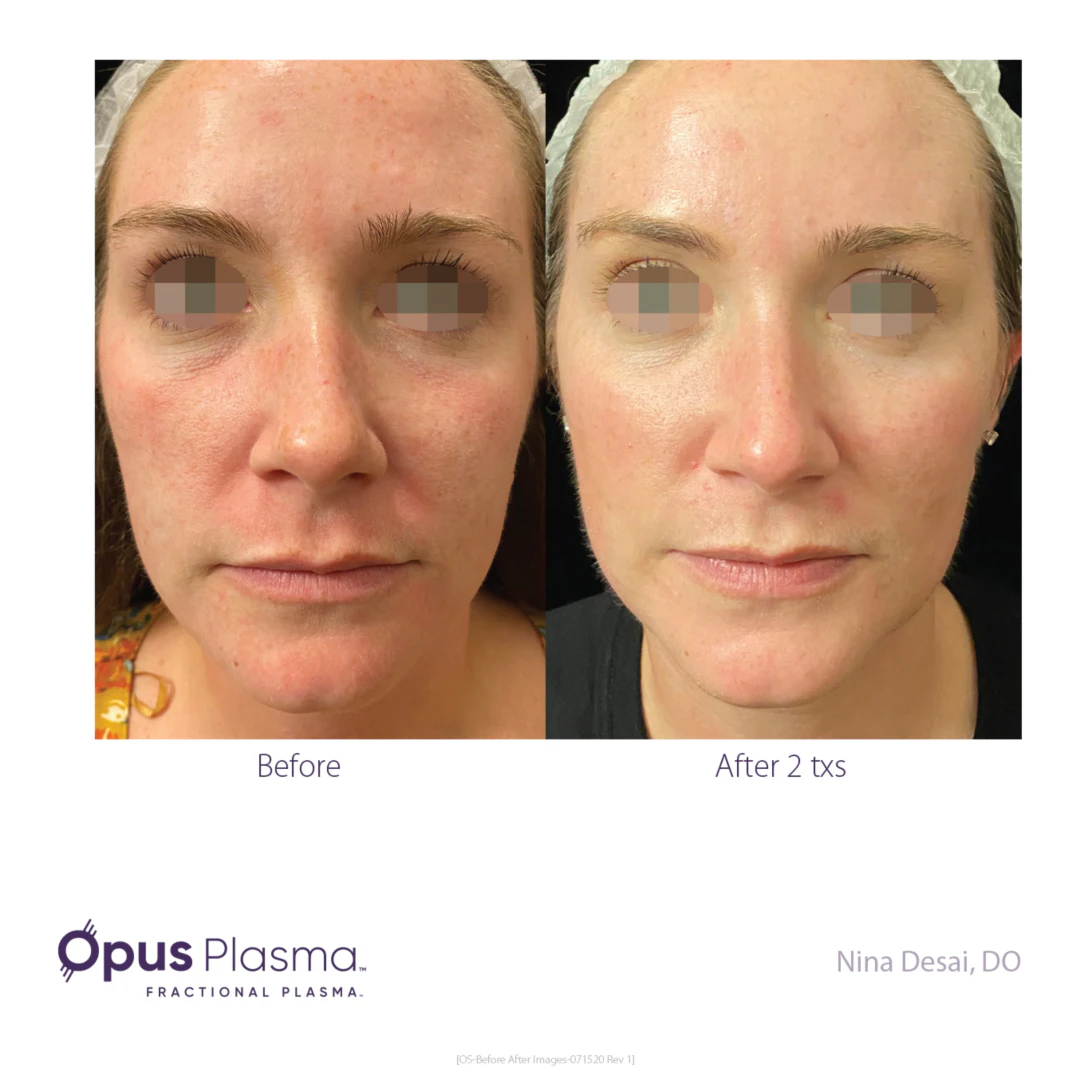 WEBP Opus Before and After B2C 1