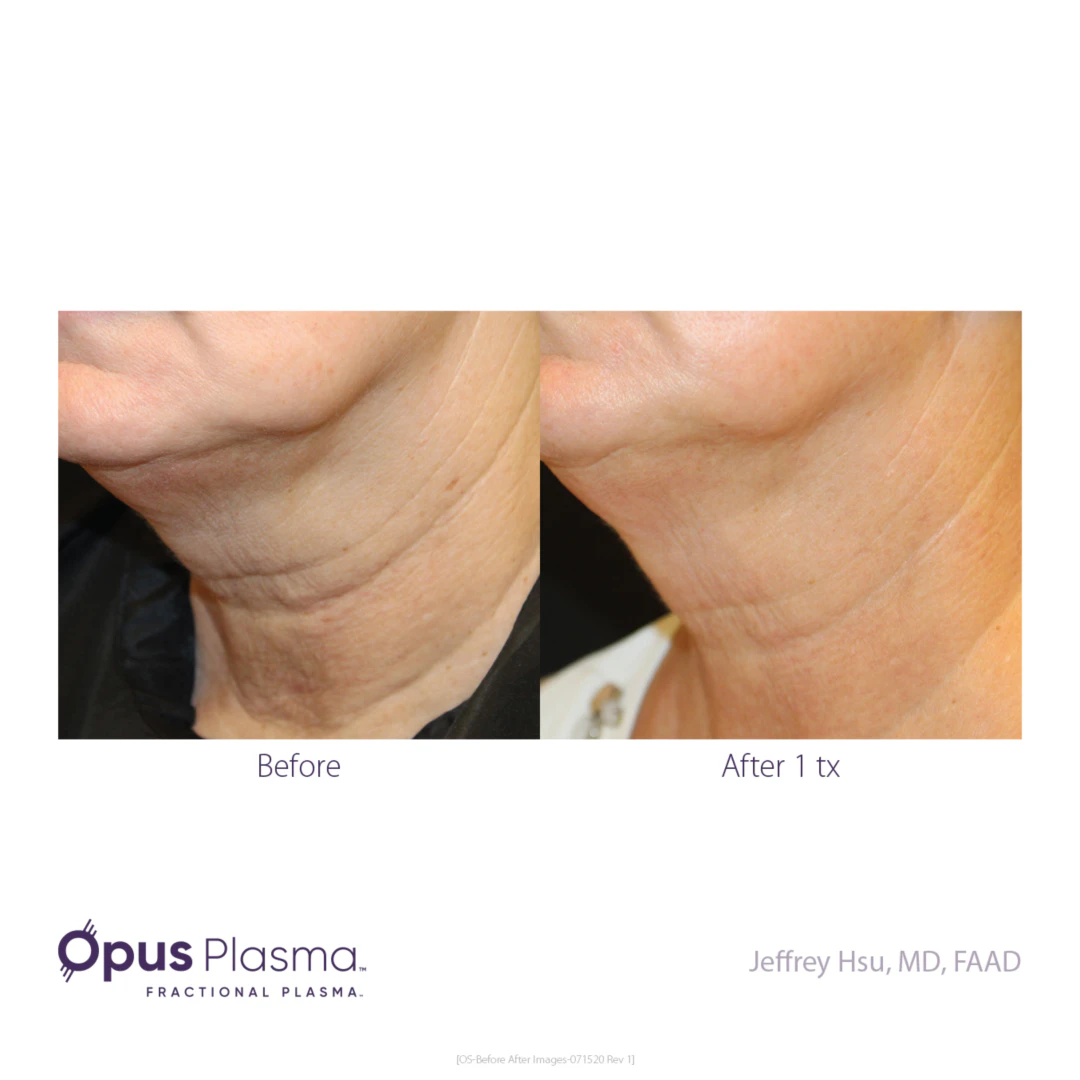 WEBP Opus Before and After B2C 3