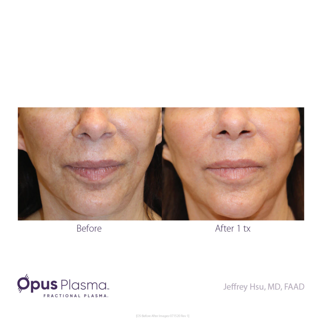 WEBP Opus Before and After B2C 7